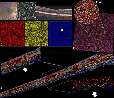 Volume Rendering of Angiographic Optical Coherence Tomography Angiography in Fovea Plana and Normal Foveal Pit